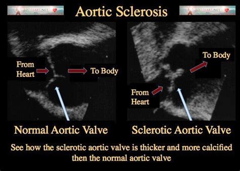 Aortic Sclerosis Diagnosis Treatments And Risk Factors Cardiac