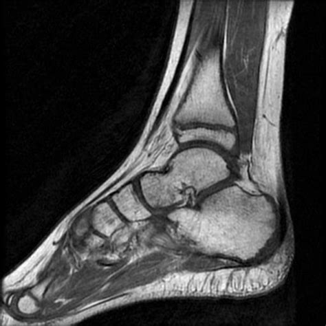 Cuboid Bone Stress Fracture Image