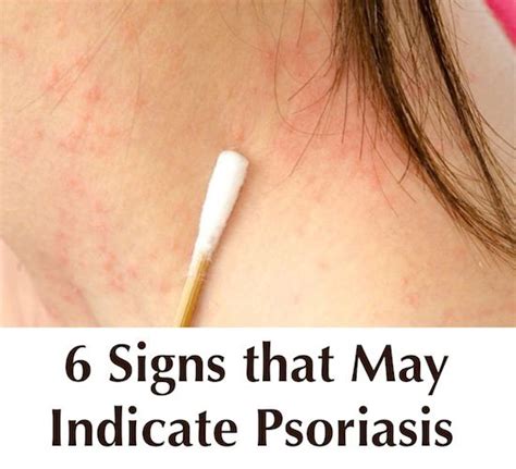 26 Best Psoriasis Arthritis Images On Pinterest Natural Remedies