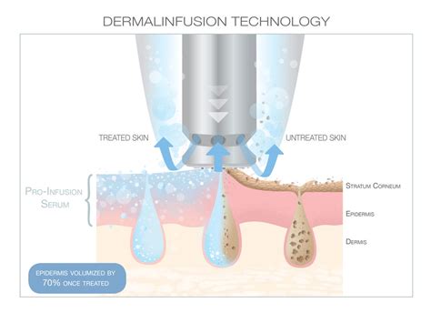 Silkpeel Dermalinfusion In Scottdale And Phoenix Az Md Skin The Lounge