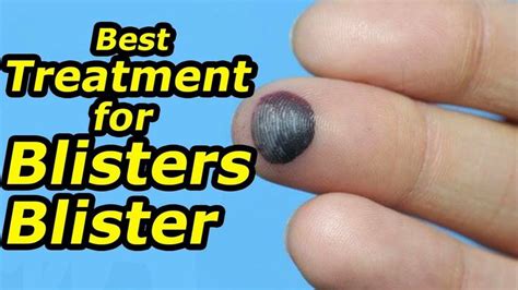 8 Natural Remedies To Get Rid Of Blood Blister Blister Treatment