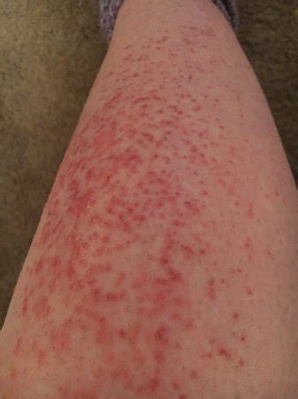 Allergic skin reaction to nair. The Nair turned on me. Please help - BabyCenter