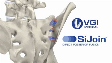 Vgi Medical Presents Sijoin® Direct Posterior Sacroiliac Si Joint