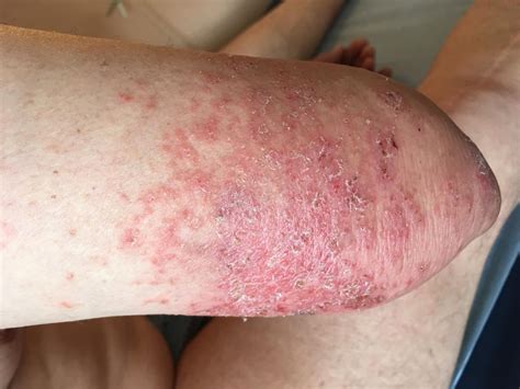 DERMATO INFO l eczéma de contact