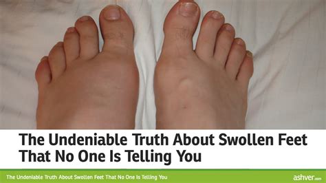 The Undeniable Truth About Swollen Feet That No One Is Telling You Youtube