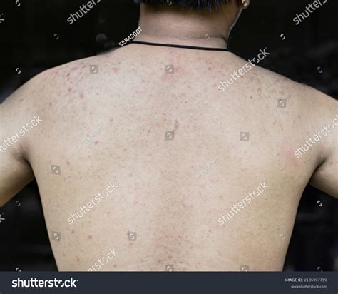 Dermatitis Rash Red Bump On Skin Stock Photo 2185997759 Shutterstock