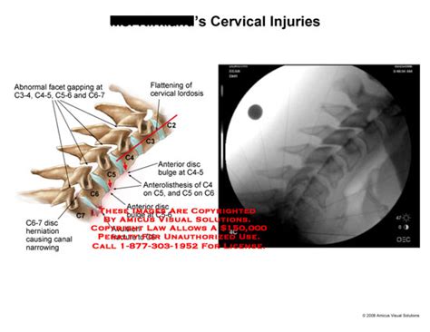 Amicus Illustration Of Amicus Injury Cervical Facet Gapping Lordosis Disc Bulge Anterolisthesis