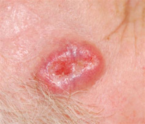 The Most Serious Type Of Skin Cancer Is Cancerwalls