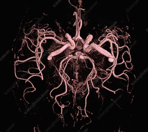 Brain Arteries Mri Angiography Stock Image C0256821 Science Photo