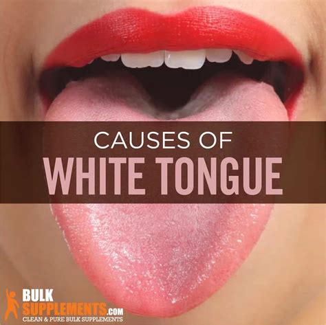 White Tongue Learn About Treatment Remedies And Supplements
