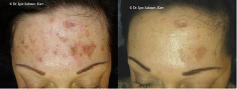 Microneedling For Collagen Induction Therapy Pigmentation And Scarring