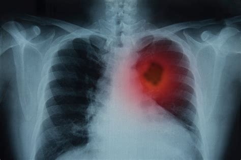 Rak Płuc Przyczyny Objawy Leczenie