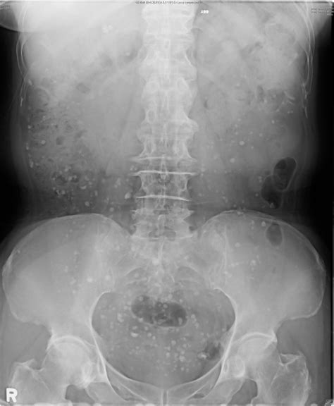 Abnormal Calcifications In A Pelvic Radiograph The Bmj