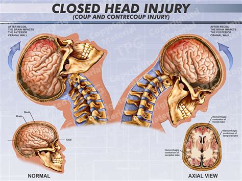 When Is A Head Injury An Automatic 911 Call Braineds