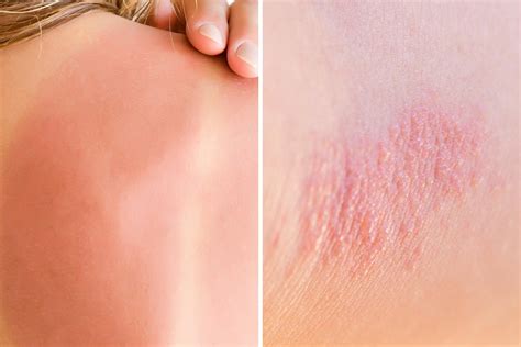 Heat Rash Between Legs Mum And Babies