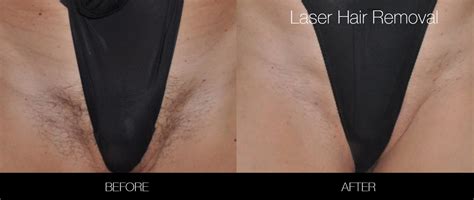Benutzer Heutige Tag Undenkbar Laser Hair Removal Bikini Area Cost