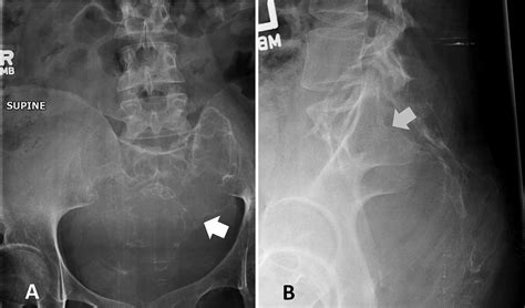 Ap A And Lateral B Radiographs Of The Lower Lumbar Spine And