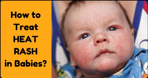 How To Treat Heat Rash In Baby Continental Clinic