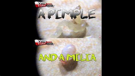 One Ingrown Hair One Blackhead And A Pimple Milia 1440p Vello