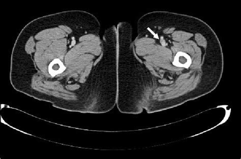 Lower Extremity Computed Tomography Venogram Showing A Thrombus Poorly