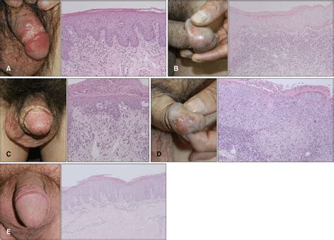 Dermatoses Of Glans Penis Showing A Similar Clinical Appearance And Download Scientific Diagram