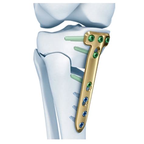 Tomofix® Medial High Tibia Plate Welcome To Sys Medtech International