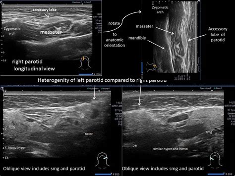 Salivary Ultrasound Standardized Diagnostic Approach And Report Iowa