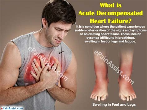 Acute Decompensated Heart Failurecausessymptomstreatmentsurgery