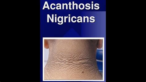 Acanthosis Nigricans Acanthosis Nigricans Tutorial Instruction