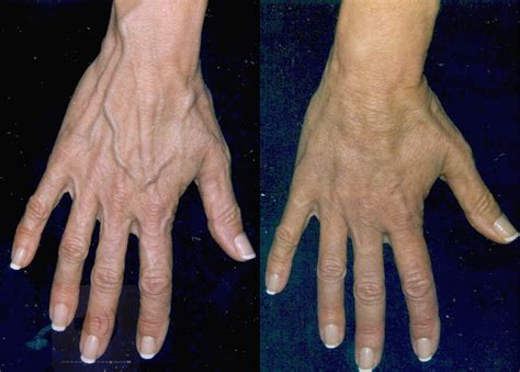 Bulging Hand Veins Permanently Removed With Rejuvahands Tm Procedure