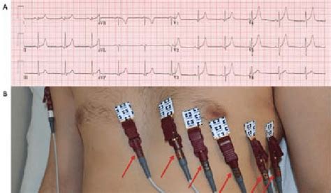 12 Lead Ecg Depicting Complete Reversal Of Leads V1 V6 A