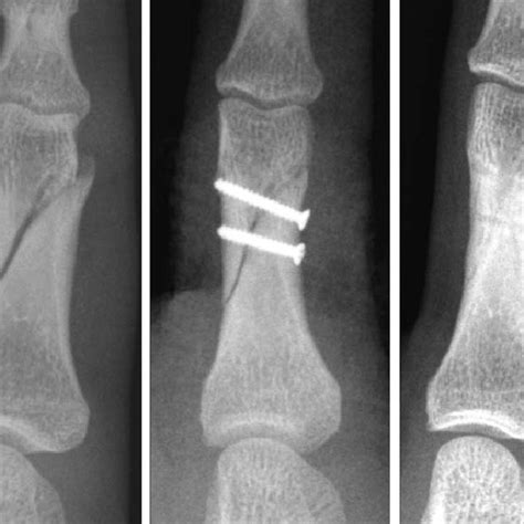 Case 2 A Comminuted Intra Articular Fracture Of The Unicondylar