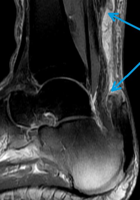 Eine achillessehnenruptur bedeutet einen abriss der achillessehne (tendo calcaneus achilles), die das fersenbein mit der wadenmuskulatur verbindet. Fuß- und Sprunggelenk - Dietrich-Bonhoeffer-Klinikum