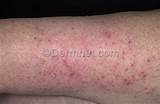 Eczema Skin Disease Treatment Images