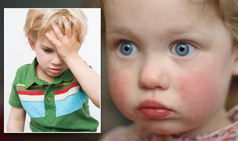 Fifth Disease The Illness ‘common In Children The Signs And