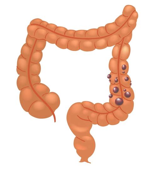 Polipy Jelita Grubego Objawy Rodzaje Przyczyny Leczenie Choroby My