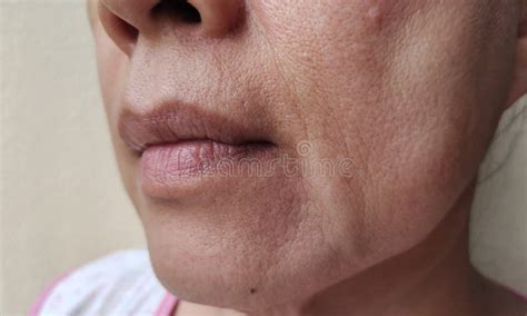 The Flabby And Wrinkles Beside The Mouth Problem Blemishes And Dark