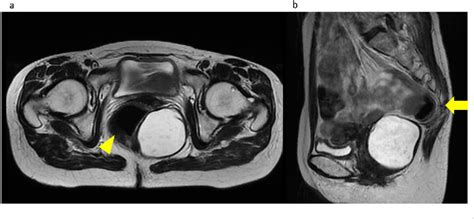 Figure 1 From Laparoscopic Surgery Of A Presacral Epidermoid Cyst A