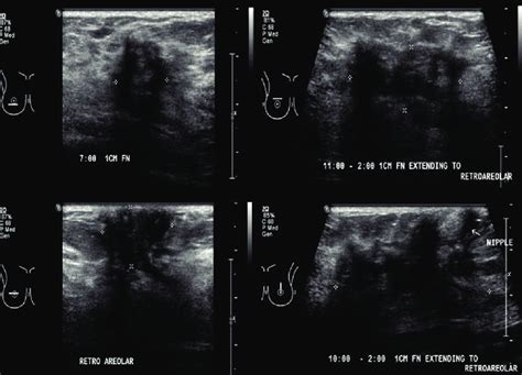 Irregular Hypoechoic Masses With Posterior Shadowing In The Right Seven