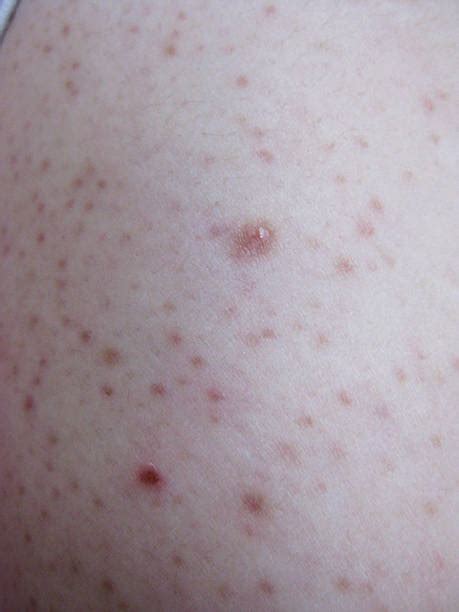 Liver Spot Stock Photos Pictures And Royalty Free Images Istock