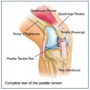 Tendonitis is caused when there is damage to a tendon. Patellar Tendon Tears - Orthopedic Specialists of Seattle