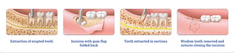 Surgical Tooth Extraction In Dubai Painless Tooth Extraction