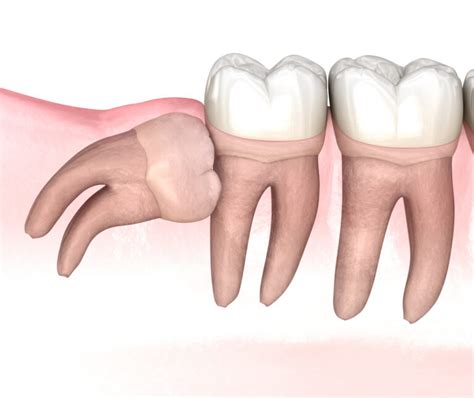 Removing Your Wisdom Teeth Santa Rosa And Rohnert Park Oral Surgery