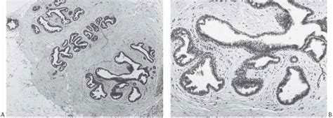 Benign Proliferative Lesions Of The Male Breast Basicmedical Key