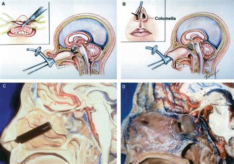 Sublabial Transseptal And Endonasal Approaches To The Sphenoid Sinus