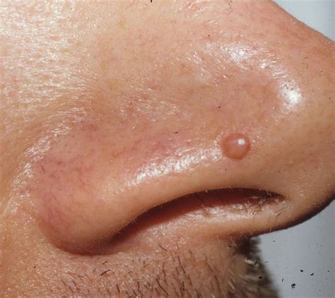 Papiloma Seno Maxilar Papilloma Wart In Nose My Xxx Hot Girl
