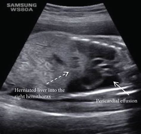 Prenatal Ultrasound Image Of Coronal Section Of The Fetal Thorax And