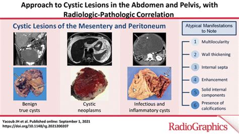 Approach To Cystic Lesions In The Abdomen And Pelvis With Radiologic