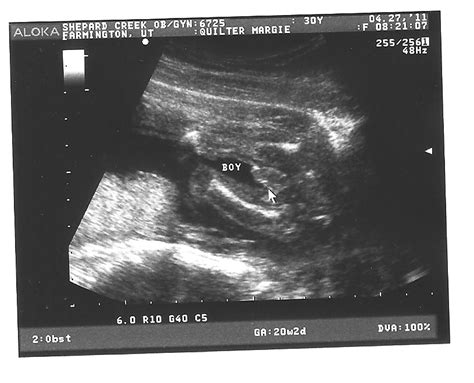 3d Ultrasound 20 Weeks Boy