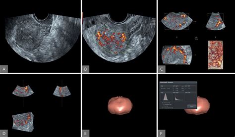 The Role Of Three Dimensional Ultrasound In Gynecology Scitemed